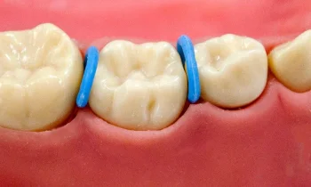 elastic separators LQ second