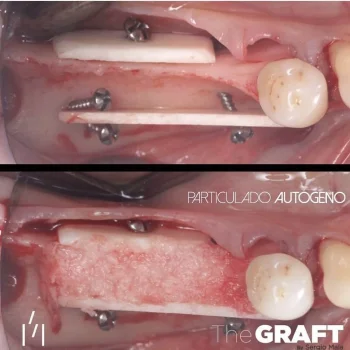 Bonefill Cortical Plate ~ 25 x 10 mm second
