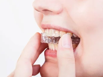 BeeDent Dental Splint Sheet